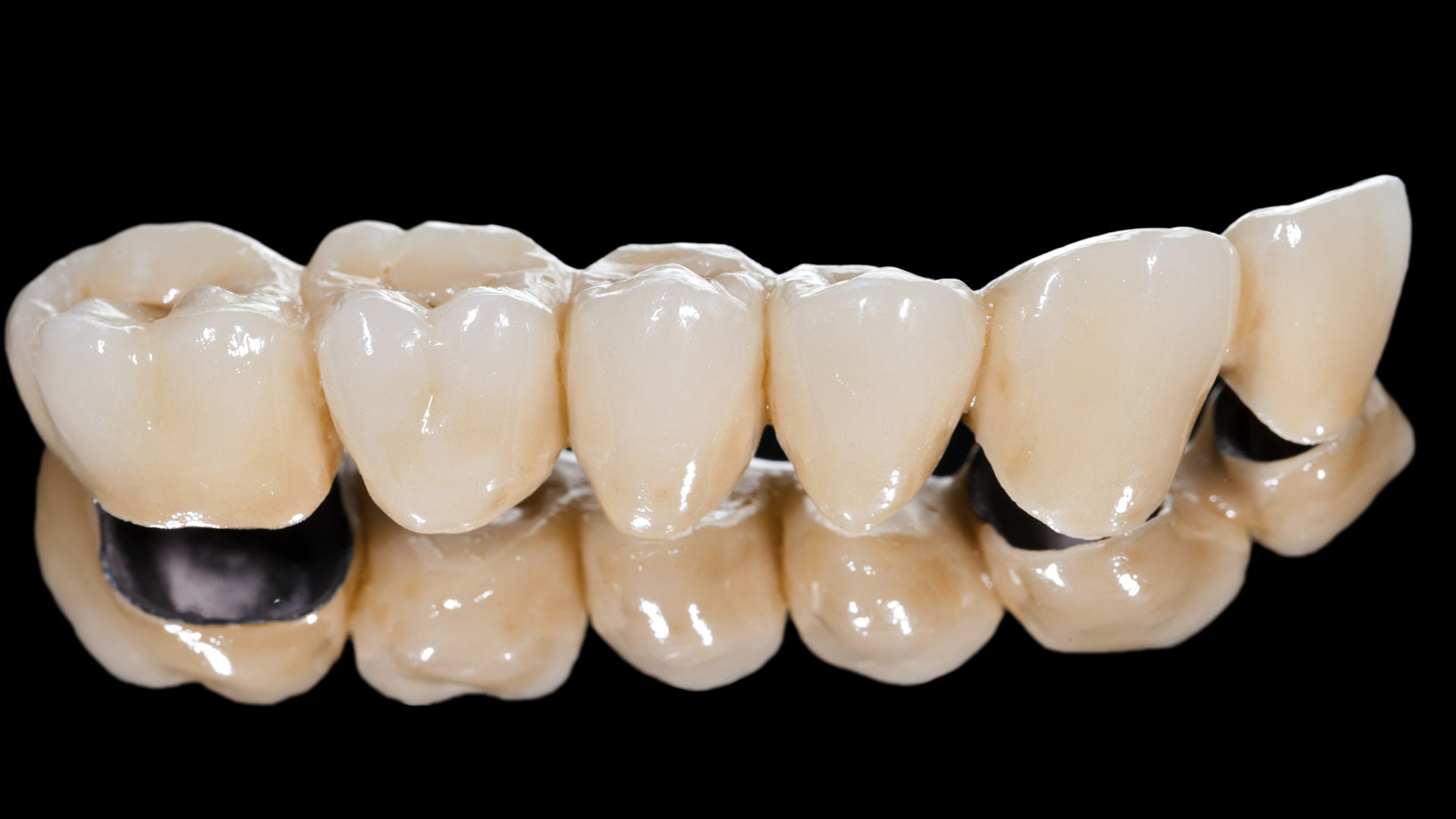 Dental Crowns and Bridges as missing tooth / teeth options.