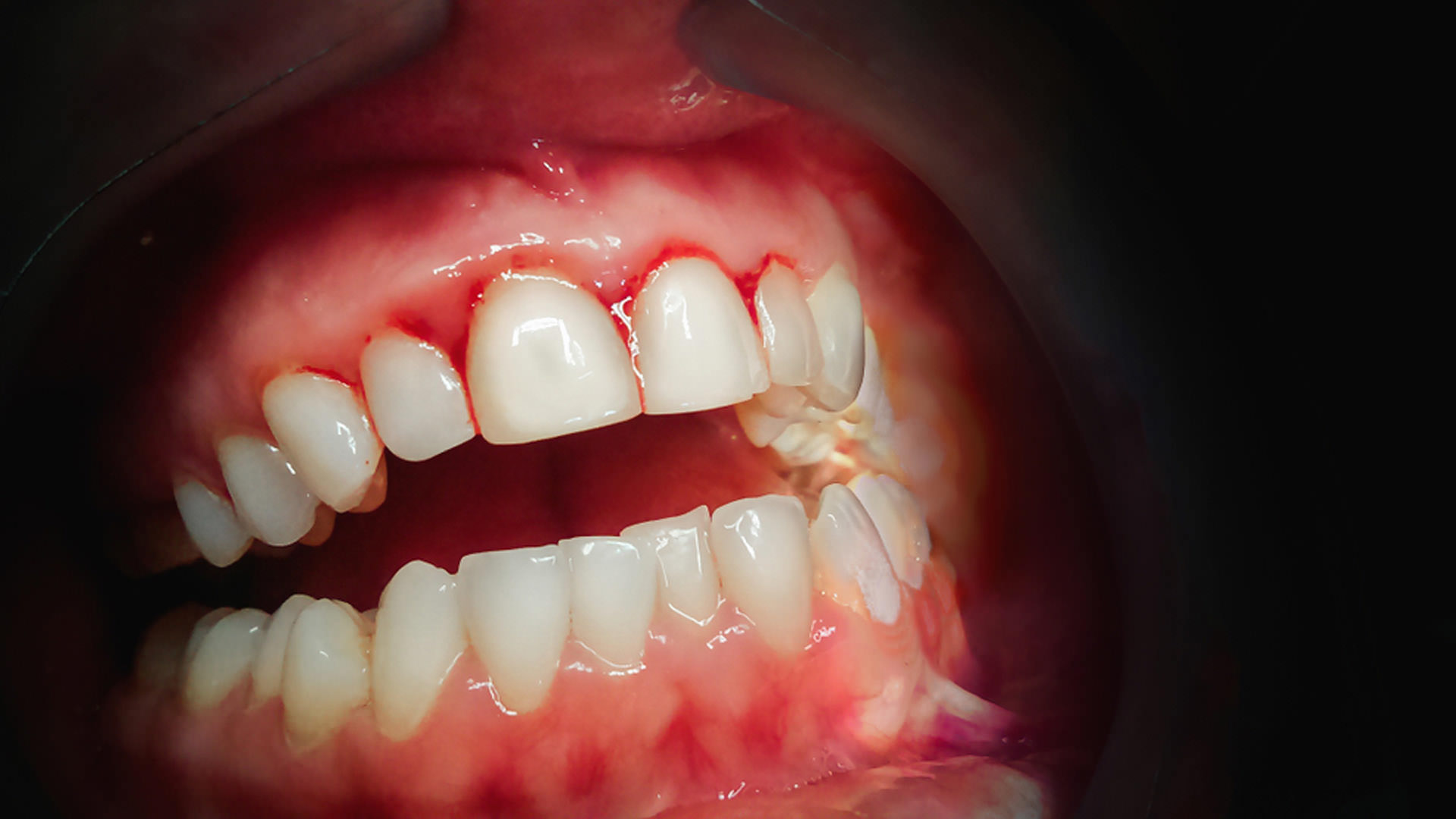 Periodontal disease (gum disease) - Butterfly Dental ...